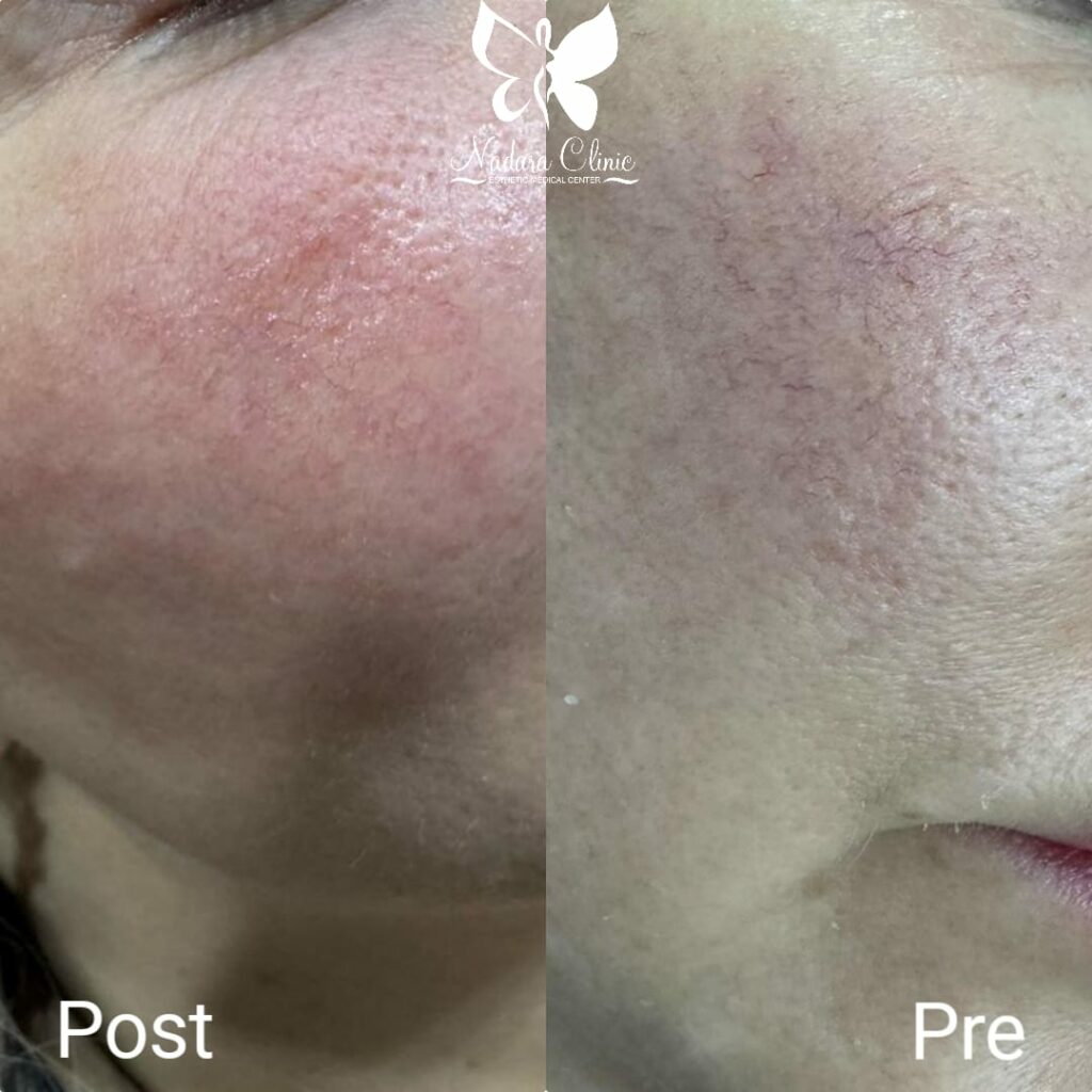 Instant result for treating spider veins